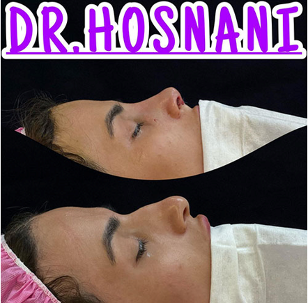 کدام مدل بینی برای چهره من مناسب تر است؟