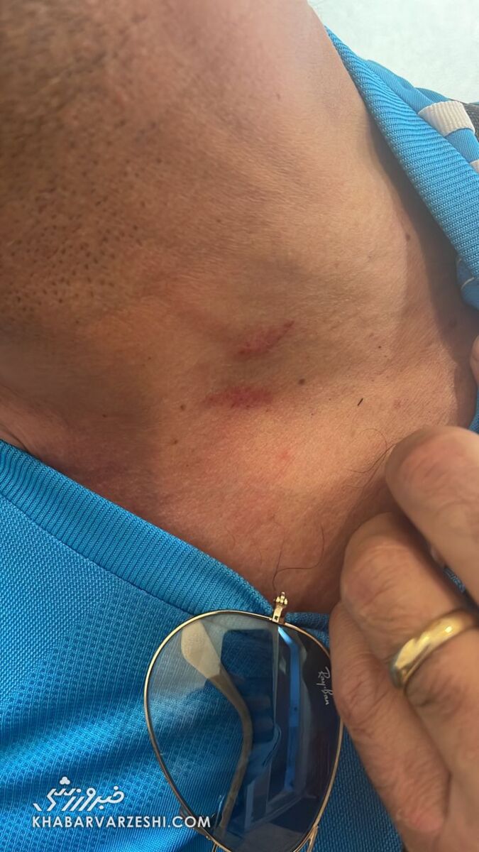 تصاویری از سرقت گردنبد و جراحت وارد شده به پیشکسوت پرسپولیس