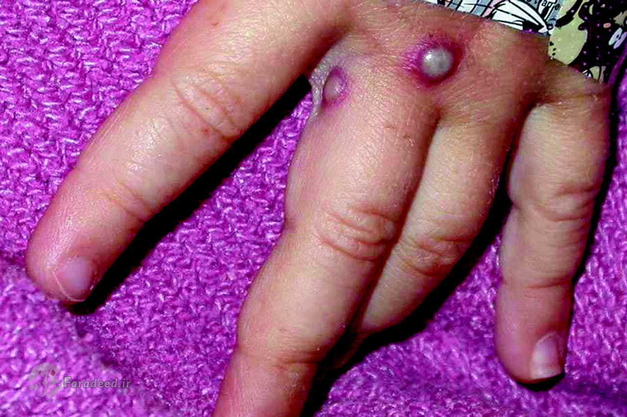  آبله میمونی در ایران 