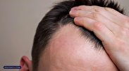 علت ریزش مو در مرد‌ان چیست؟