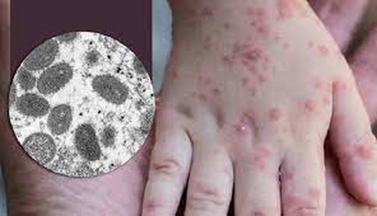 انجام ۲۹۱ تست آبله میمونی در کشور؛ تاکنون/نیازی به واکسیناسیون آبله وجود دارد؟