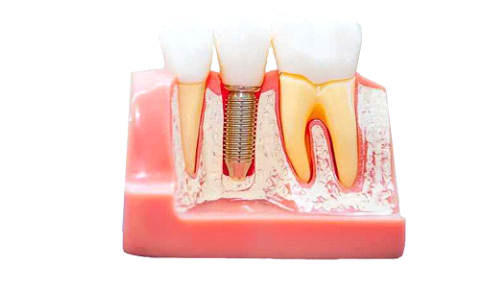 آیا ایمپلنت دندان خوب است؟