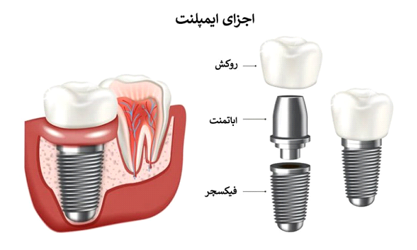 آیا ایمپلنت دندان خوب است؟