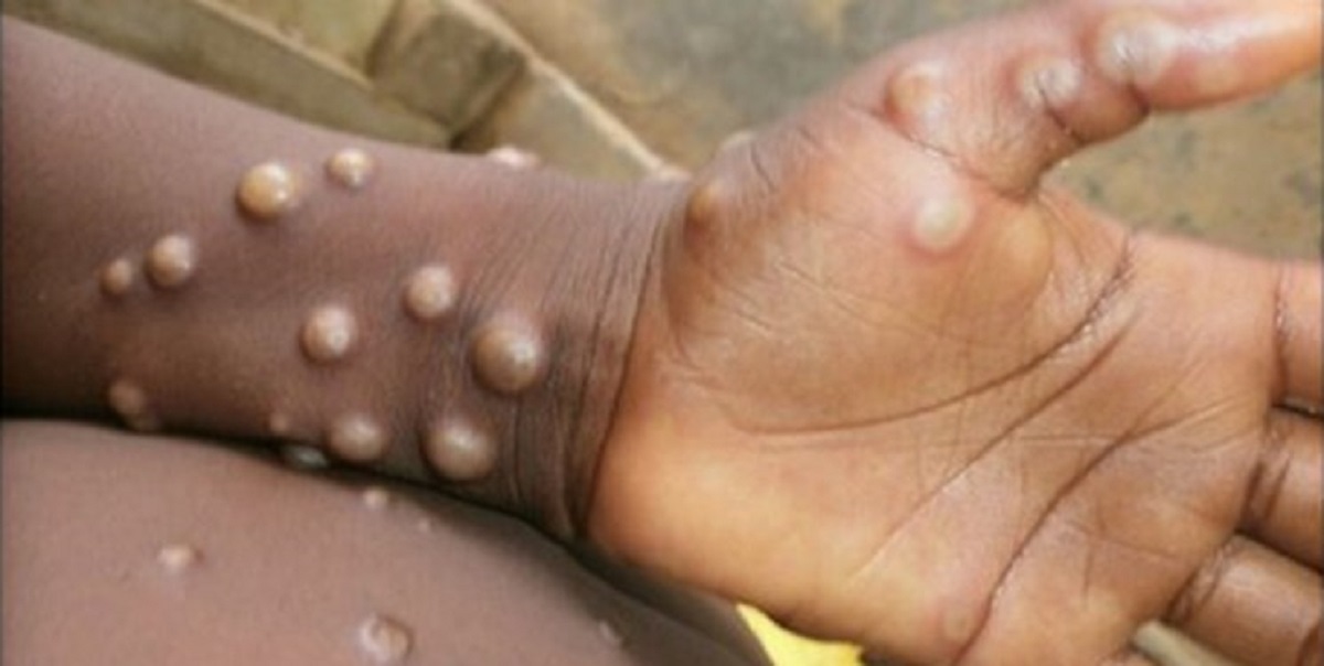 تایید واکسن آبله میمونی در اتحادیه اروپا