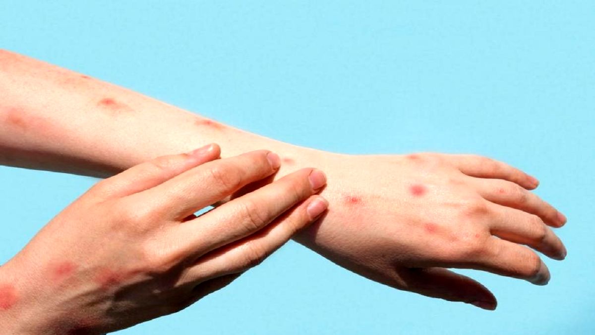 علائم آبله میمونی و آبله مرغان