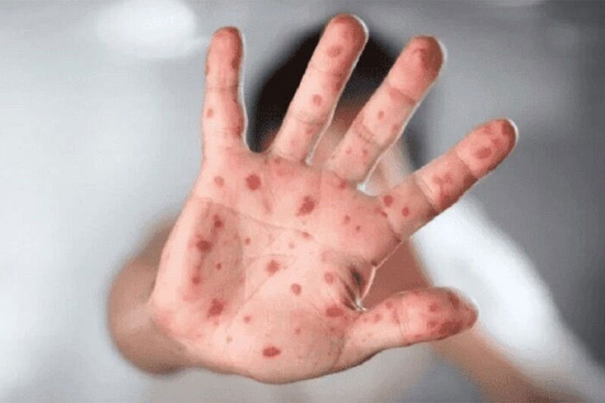 علائم ابتلا به آبله میمون علائم ابتلا به آبله میمون