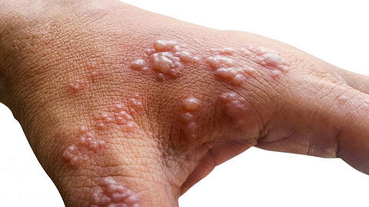 آبله میمونی