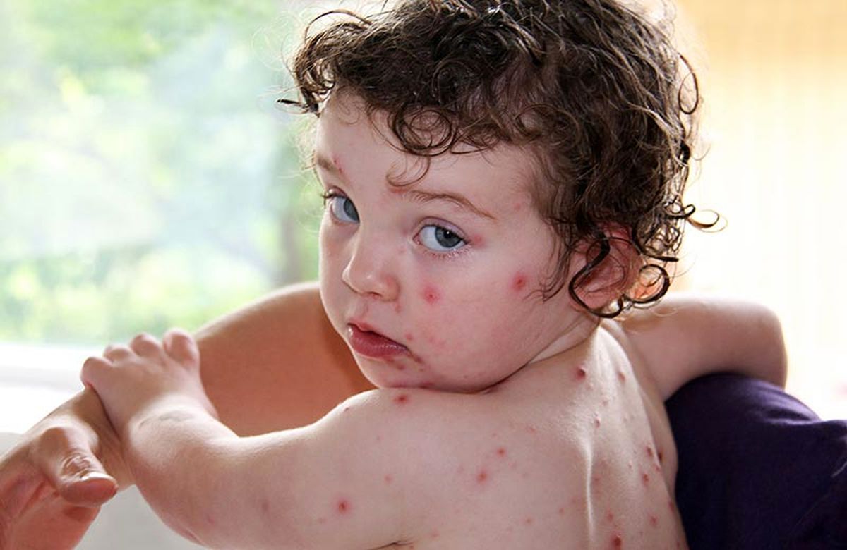 تب گوجه‌فرنگی