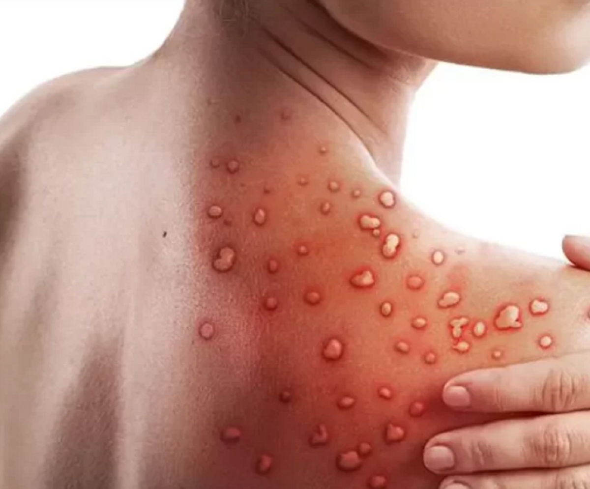 علائم آبله میمونی