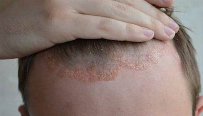 انواع اگزمای پوستی، علائم و روش‌ درمان