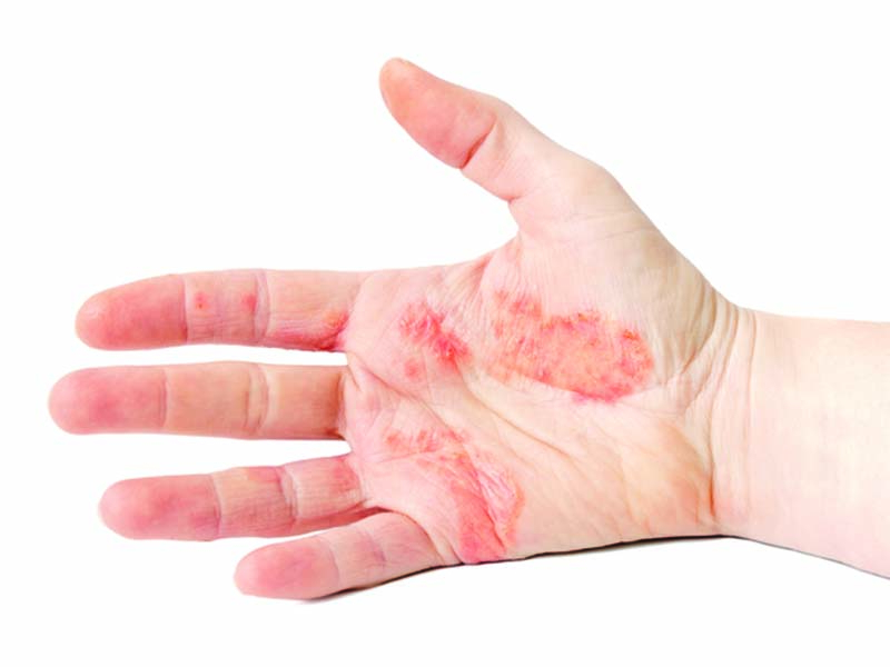 انواع اگزمای پوستی، علائم و روش‌ درمان