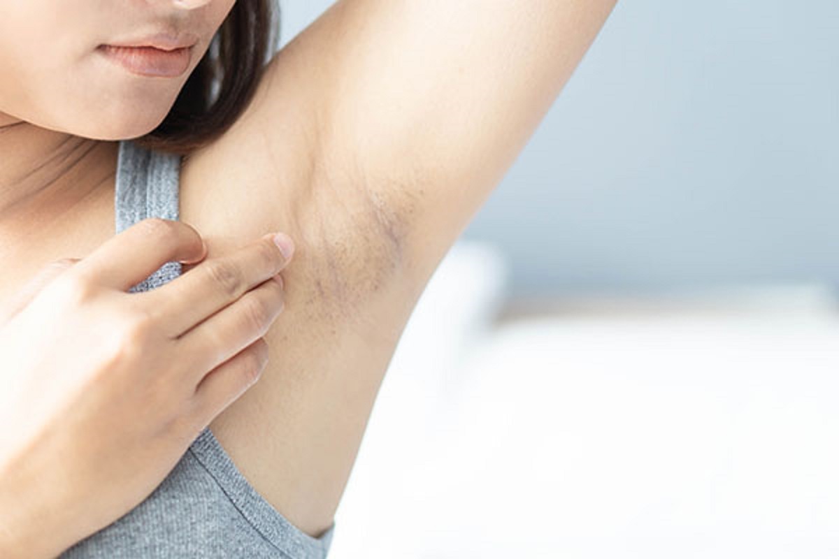 از بین بردن سیاهی زیر بغل