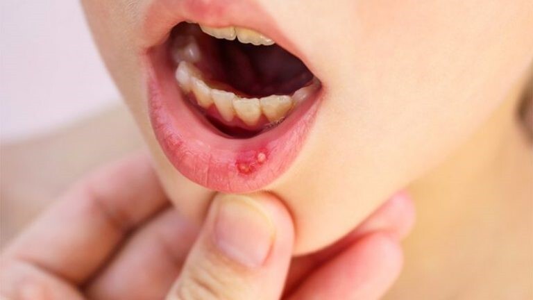 علت تاول زدن لثه چیست؟ علت تاول زدن لثه چیست؟