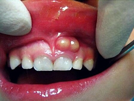 روش هایی برای درمان آبسه و عفونت دندان