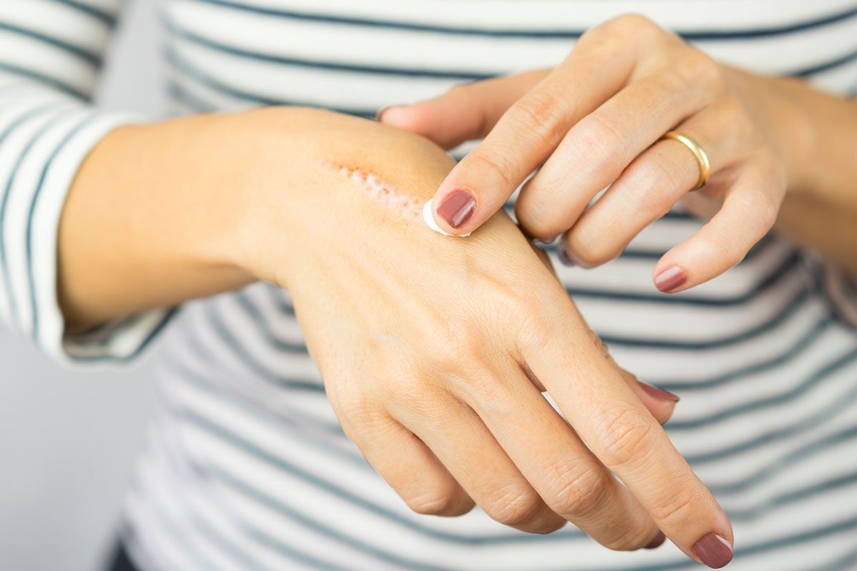 بهترین پماد برای از بین بردن جای زخم