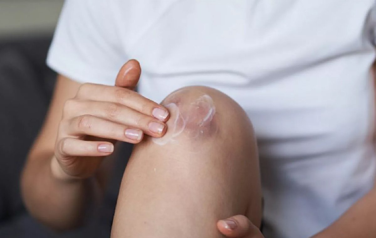 بهترین پماد برای از بین بردن جای زخم