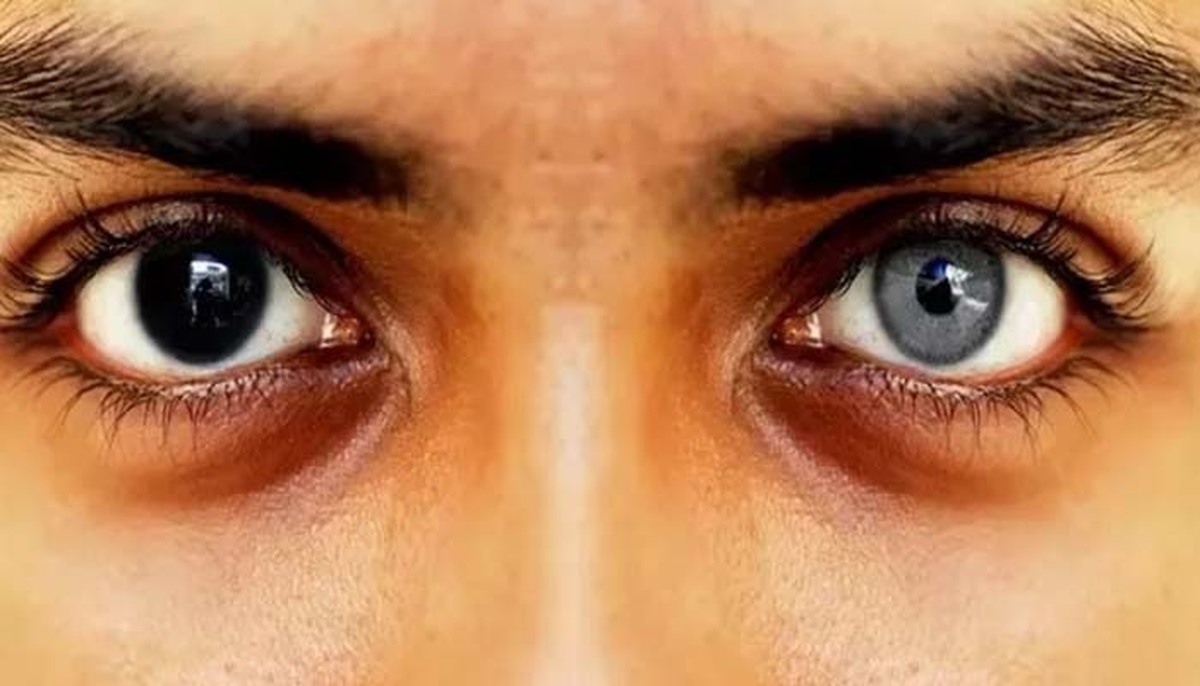 جراحیهای زیبایی به جاهای باریک کشید؛ عمل ۲۵۰ میلیون تومانی برای تغییر رنگ چشم! جراحیهای زیبایی به جاهای باریک کشید؛ عمل ۲۵۰ میلیون تومانی برای تغییر رنگ چشم!