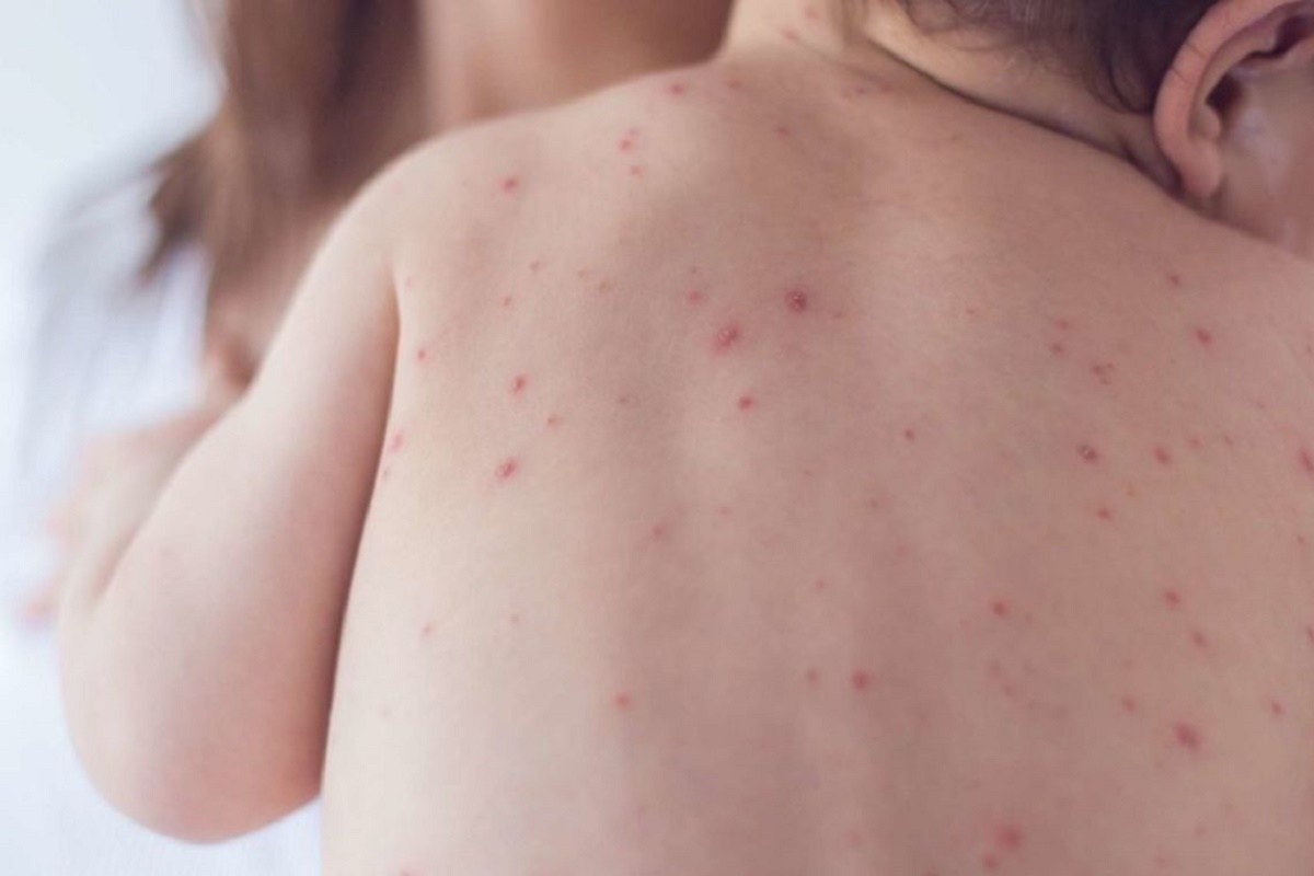 طغیان سرخک در مرزهای ایران طغیان سرخک در مرزهای ایران