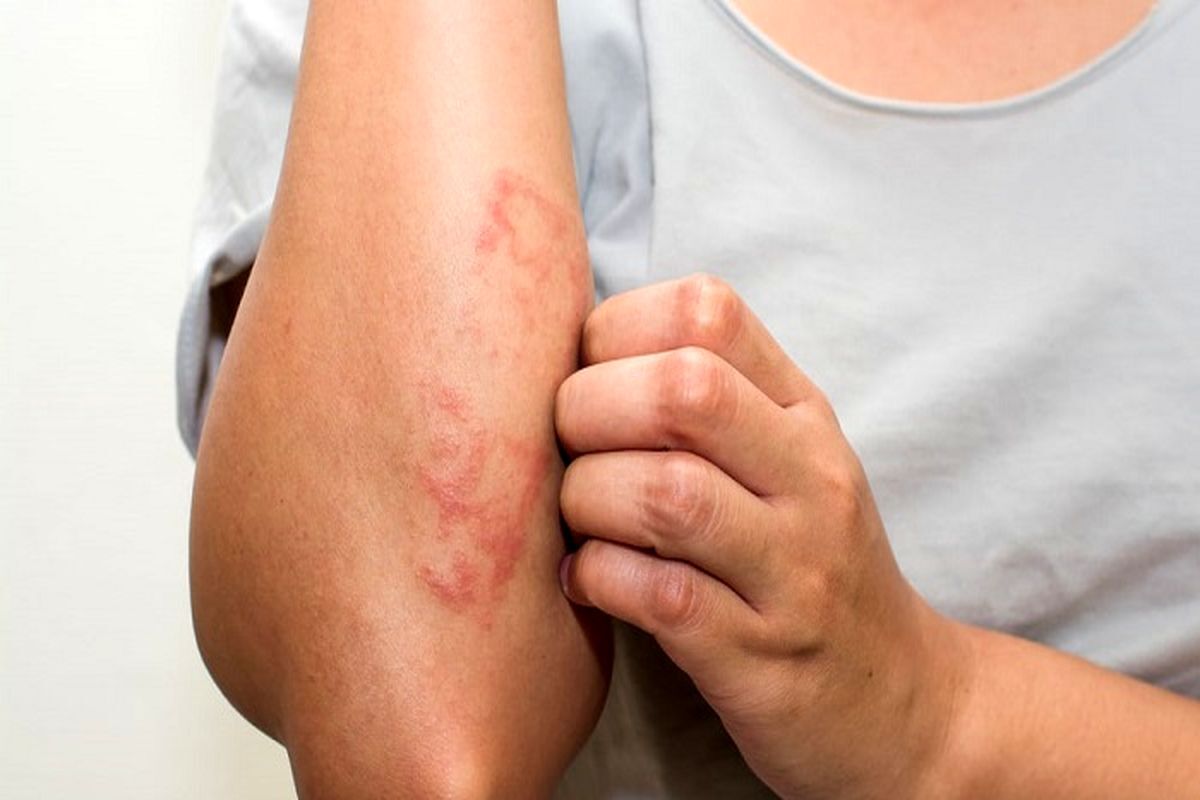 بیماری پوستی گال چیست؟