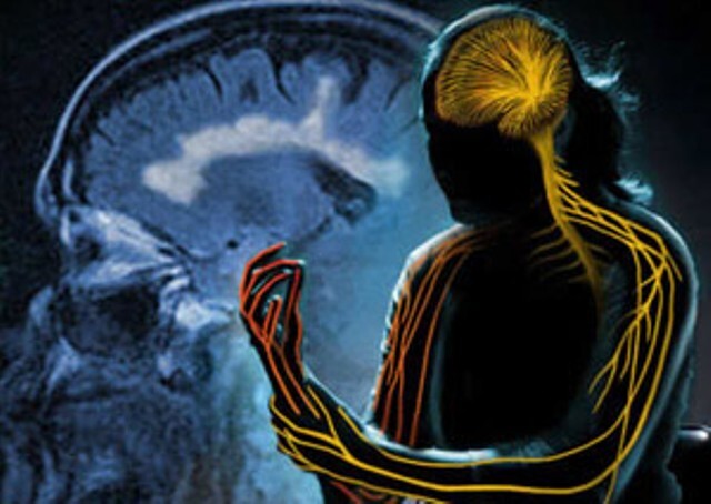 بیماری ام اس چگونه شروع می‌شود؟