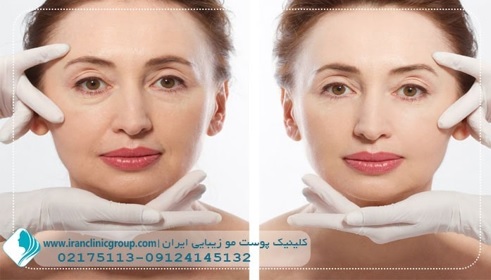 ده نکته ی طلایی در مورد تزریق بوتاکس ده نکته ی طلایی در مورد تزریق بوتاکس