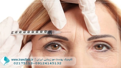 ده نکته ی طلایی در مورد تزریق بوتاکس ده نکته ی طلایی در مورد تزریق بوتاکس