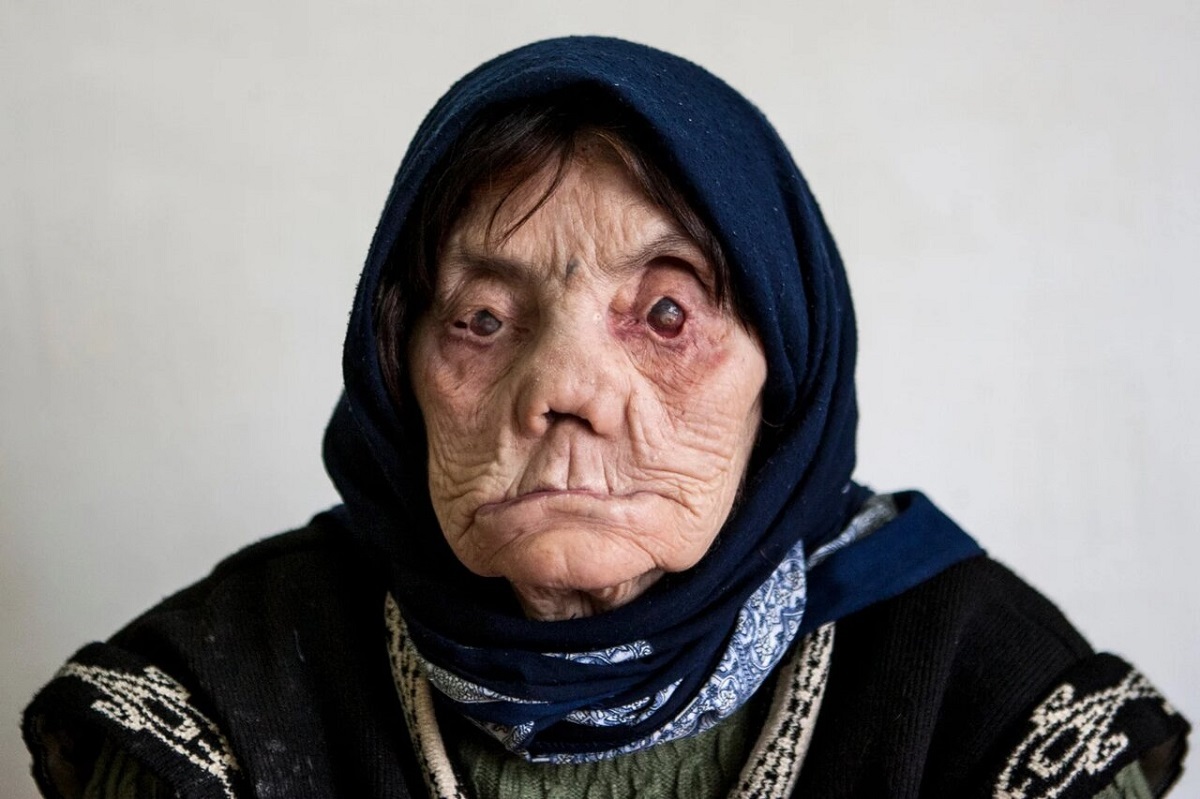 آمار مبتلایان جذام در ایران بالاخره منتشر شد؛ این رقم ترسناک است