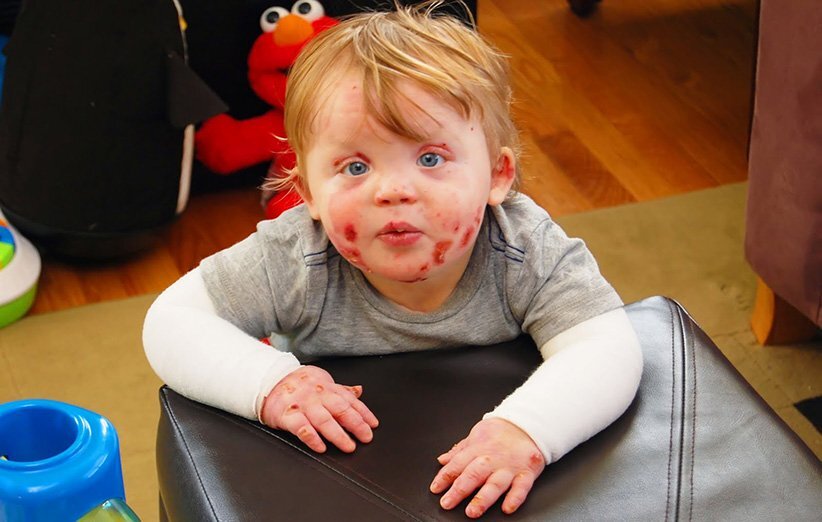 بیماری پروانه‌ای چیست؟