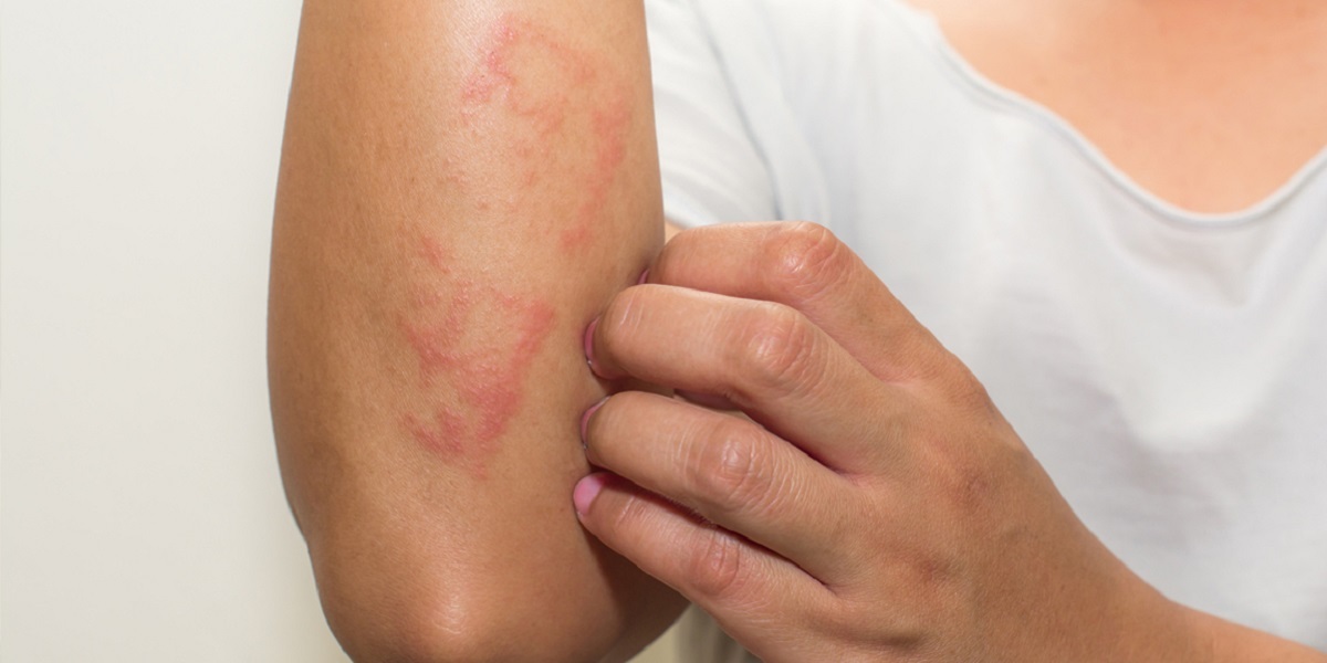 بیماری زونا چیست؟ بیماری زونا چیست؟