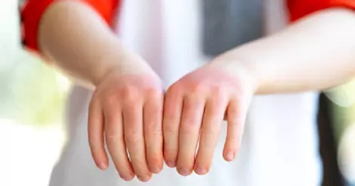 روماتیسم پوستی چیست؟