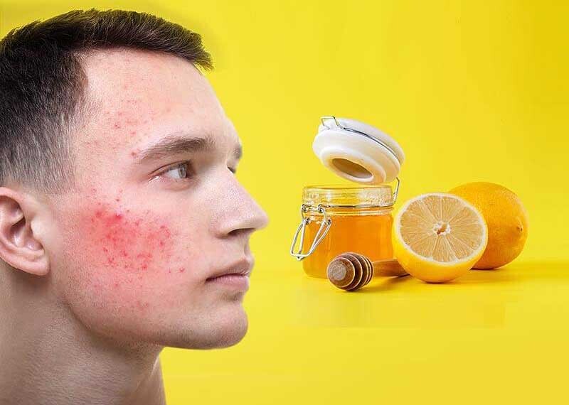 بهترین راهکار برای لک صورت بهترین راهکار برای لک صورت