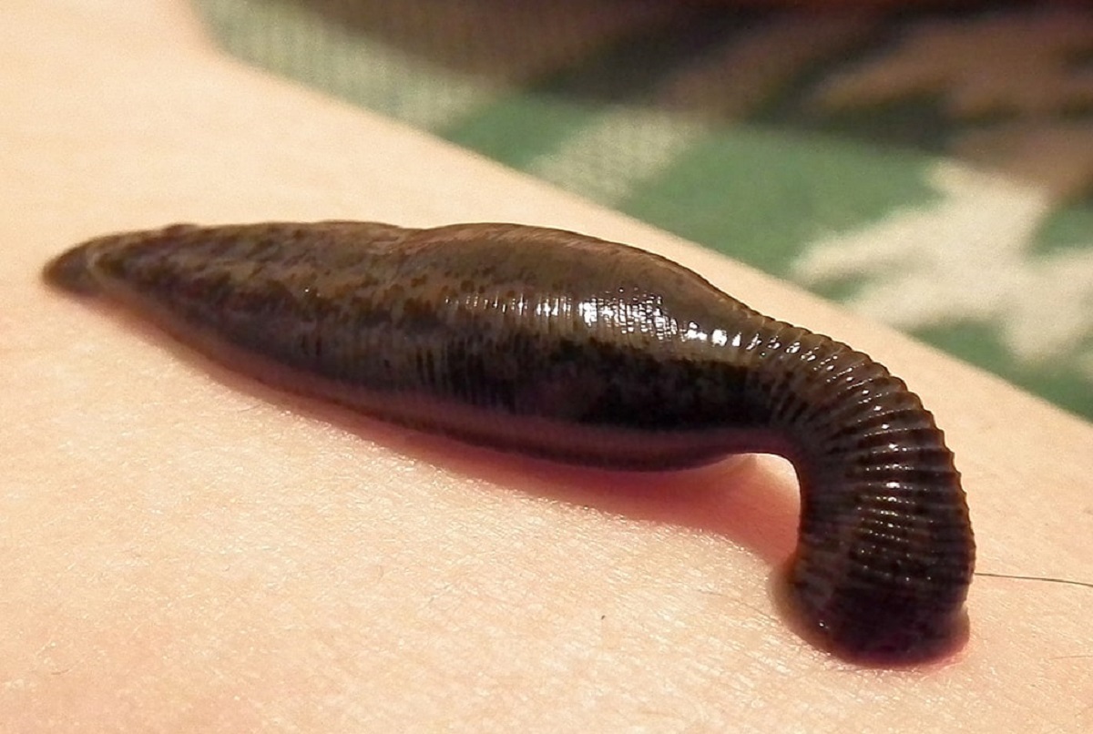 انتقال بیماری ایدز از طریق زالوی آلوده و ضعف نظارت بر طب سنتی