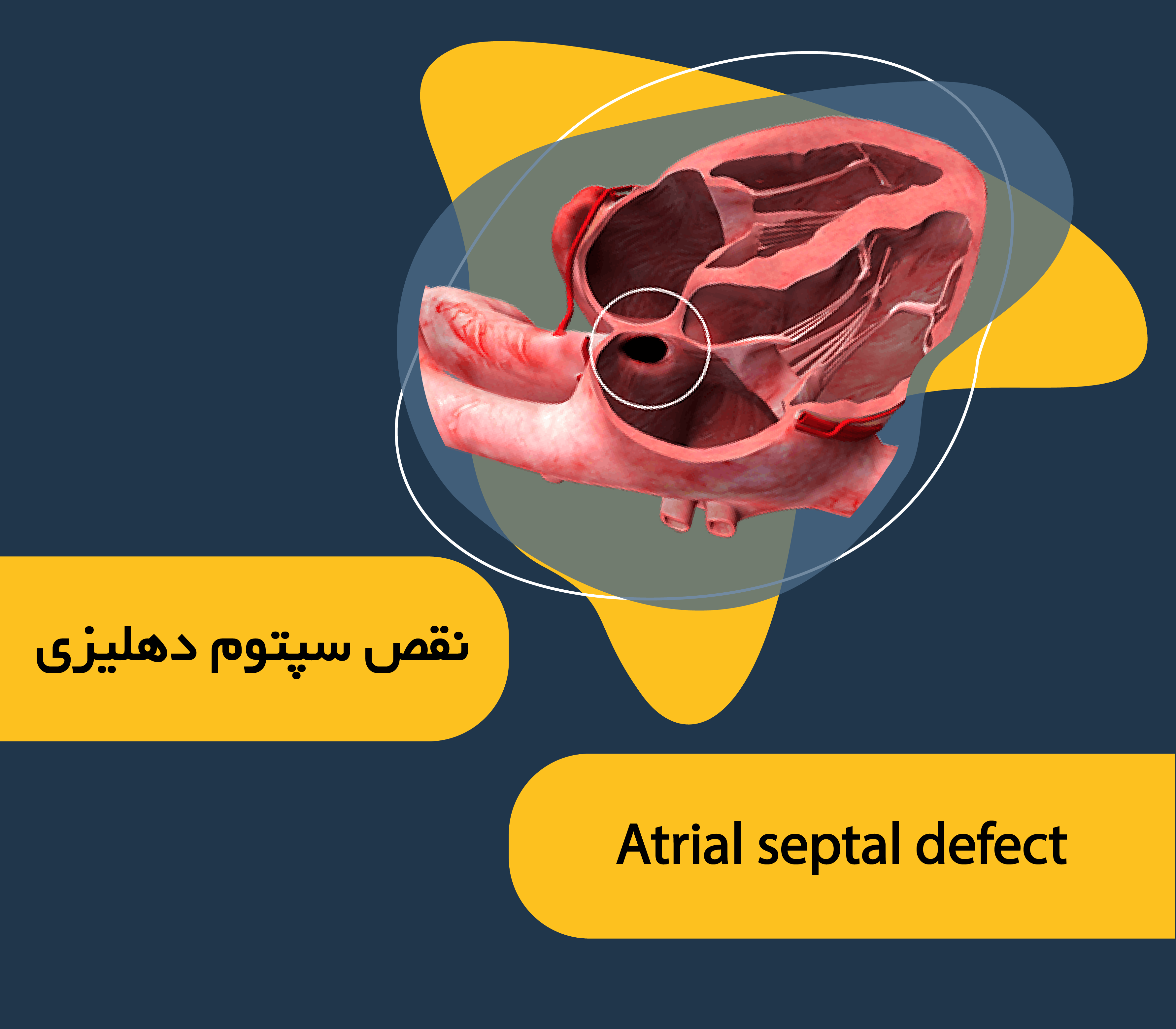بیماری قلبی مادرزادی vsd چیست؟ بیماری قلبی مادرزادی vsd چیست؟