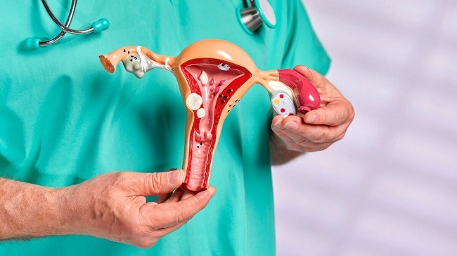 آندومتریوز چیست؟