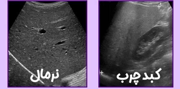 کبد چرب چیست؟ بررسی گریدهای مختلف و علائم هر کدام کبد چرب چیست؟ بررسی گریدهای مختلف و علائم هر کدام