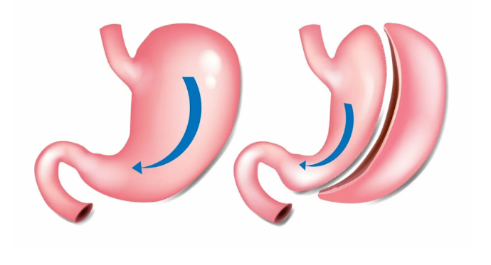 دکتر محمد ایرانمنش؛ بهترین دکتر برای اسلیو معده در تهران