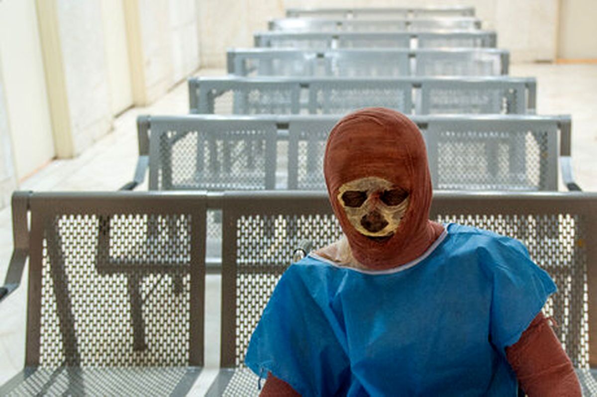 سالانه حدود ۱۰ هزار نفر به دلیل سوختگی از کارافتاده میشوند سالانه حدود ۱۰ هزار نفر به دلیل سوختگی از کارافتاده میشوند