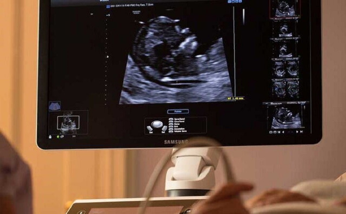 سقط جنین سقط جنین