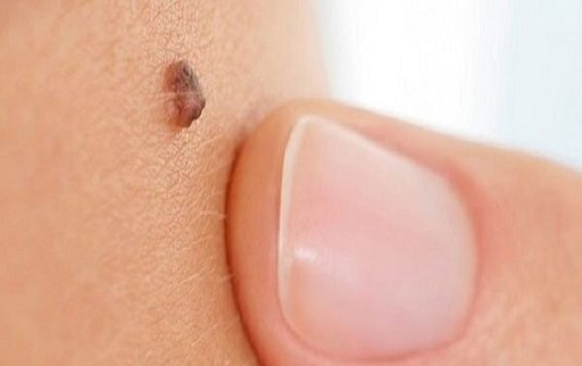 علامت مهم خال سرطانی را بشناسید