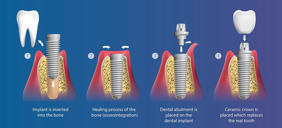 نظرات در مورد ایمپلنت دیجیتال