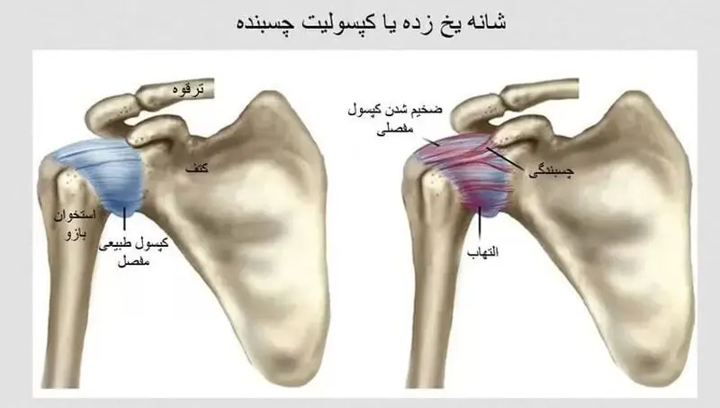 شانه یخ‌زده چیست؟