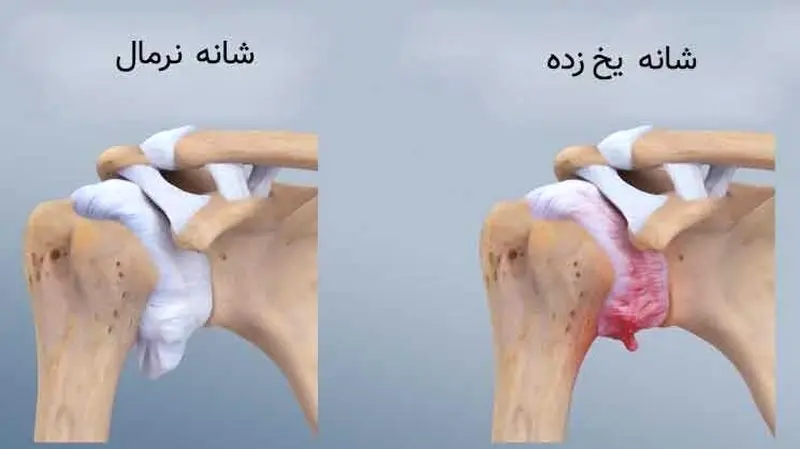 راههای جلوگیری از شانه یخ زده