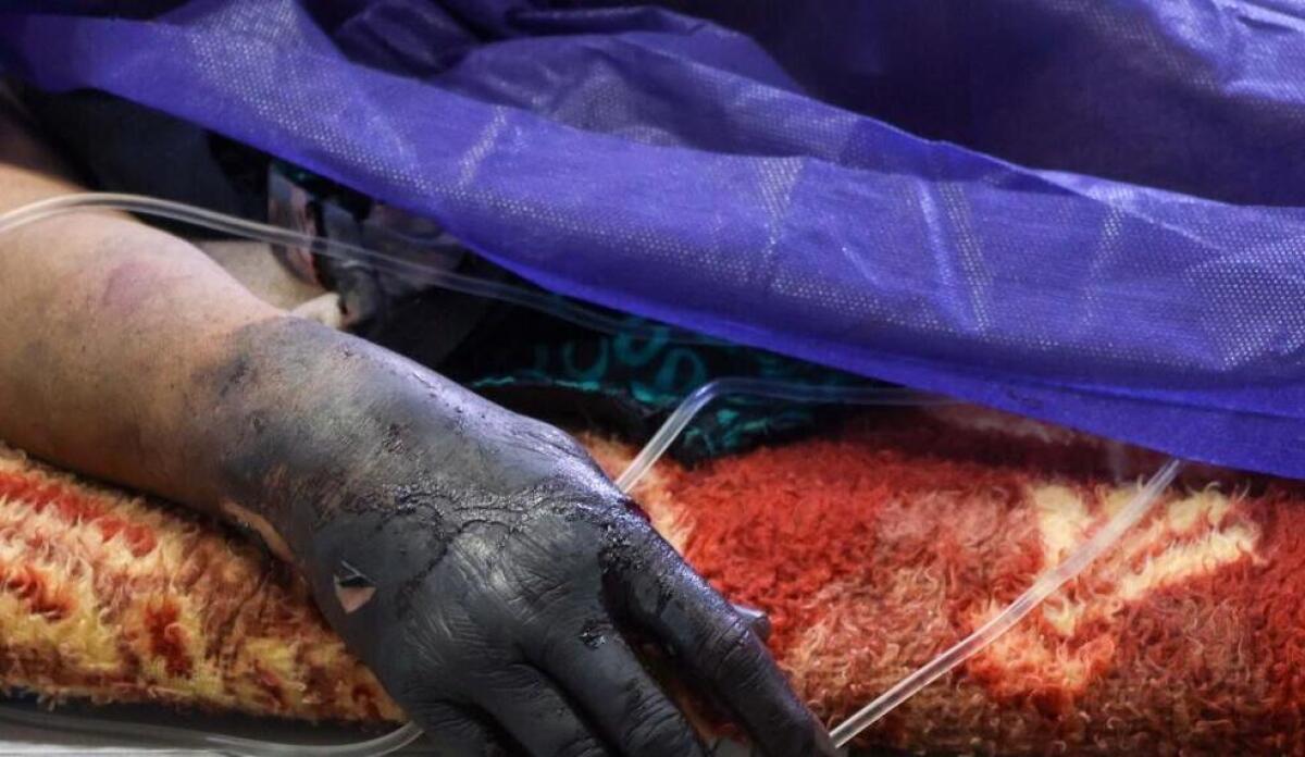 ۴۲۷ نفر در حوادث چهارشنبه سوری مصدوم شدند | ۲۰ نفر قطع عضو