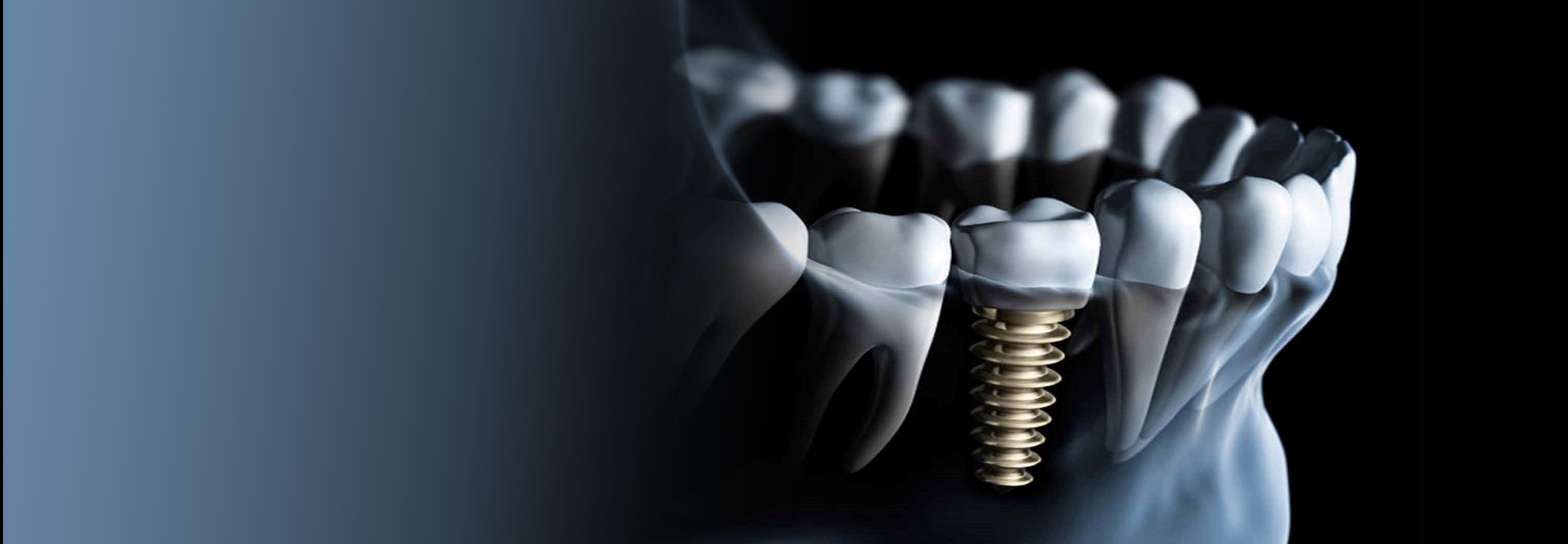 نظر کاربران در مورد ایمپلنت دندان