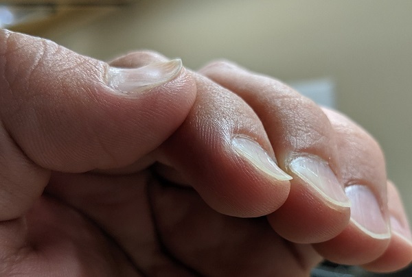 از روی ناخن و کف دست پی به کم خونی ببرید! از روی ناخن و کف دست پی به کم خونی ببرید!