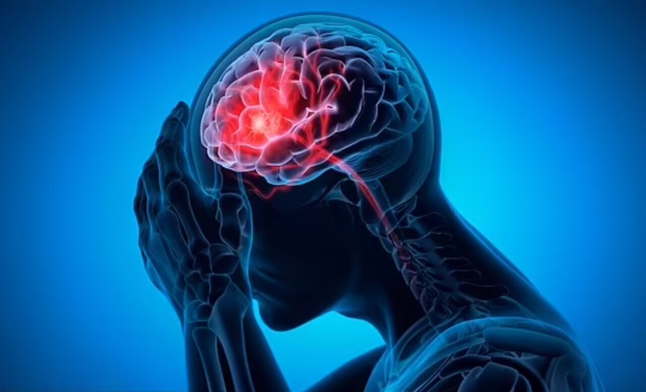 شایع‌ترین علت خونریزی مغزی را بشناسیم