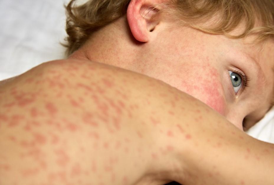 افزایش نگرانکننده سرخک و سرخجه؛ کودکان زیر ۹ سال قربانیان اصلی بیتوجهی به واکسیناسیون سرخک