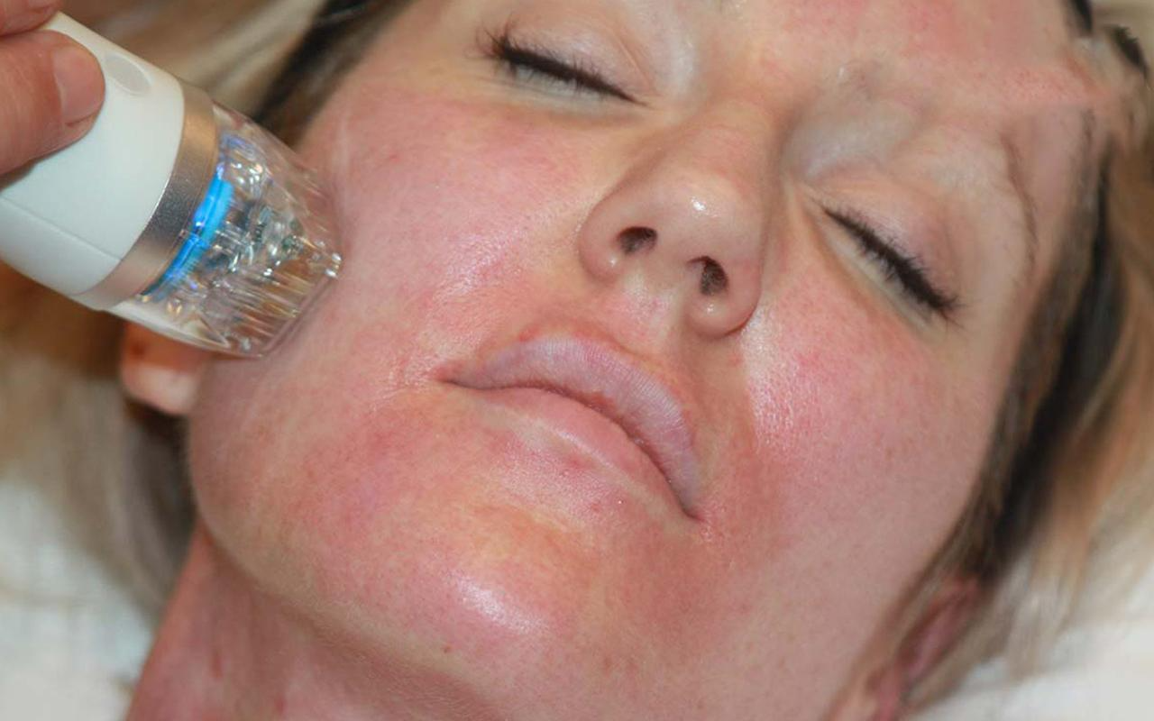 بهترین و سریعترین روش برای جوانسازی و سفتی پوست صورت