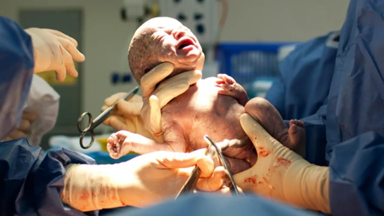 پشت پرده آمار بالای سزارین در کشور چیست؟