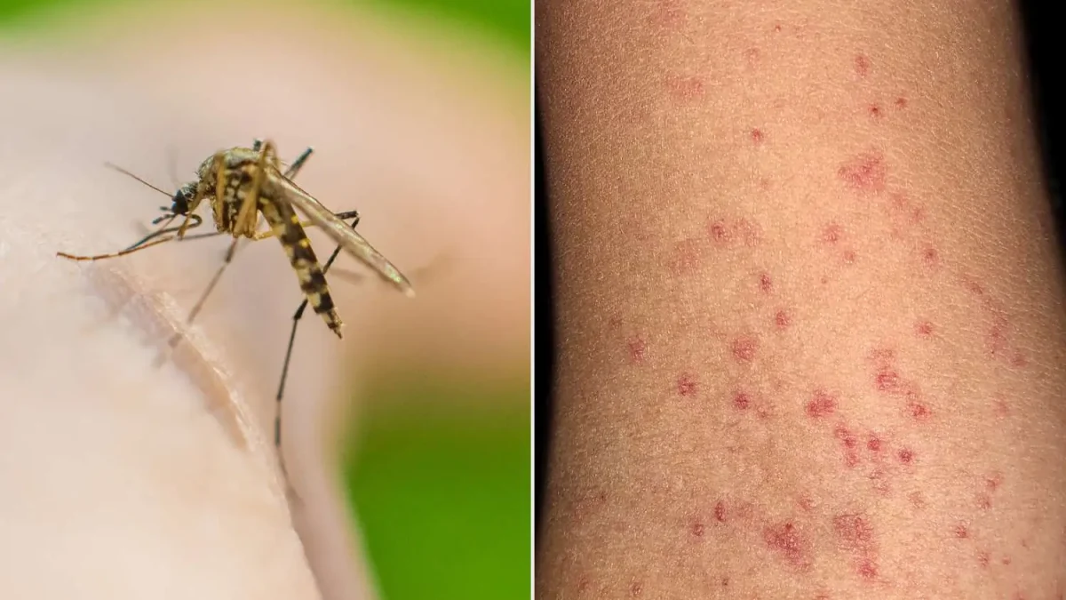 زنگ خطر شیوع تب دنگی در این منطقه به صدا در آمد